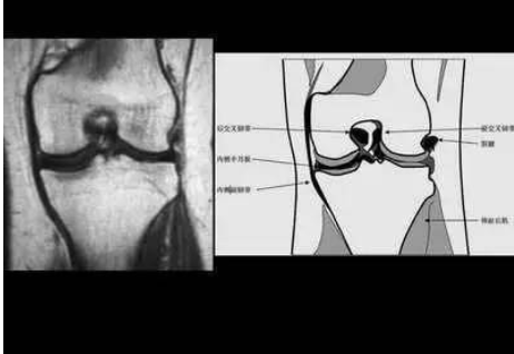 运动员的半月板撕裂意味着什么？