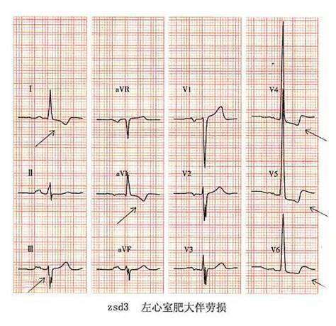 “左心室高电压”是什么意思？