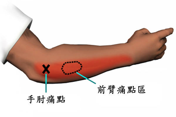 网球肘用什么方法能彻底治好呢？