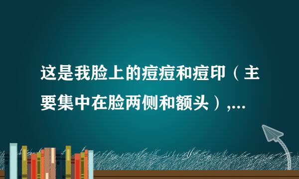 这是我脸上的痘痘和痘印（主要集中在脸两侧和额头）,怎么祛痘，痘印? 用了好多化妆品不管用。18岁女生