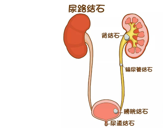 女子天生有4个肾、4条输尿管，竟全长了结石！女子现在的身体状况如何？