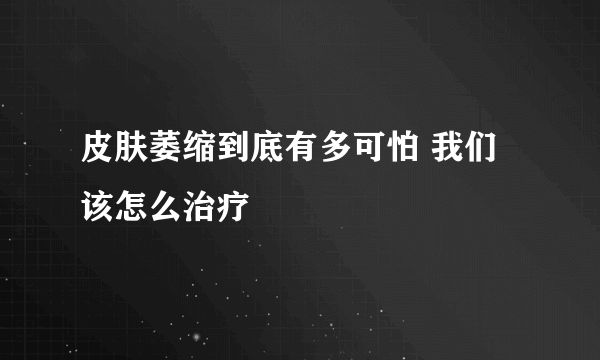 皮肤萎缩到底有多可怕 我们该怎么治疗