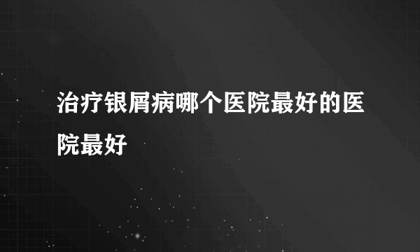 治疗银屑病哪个医院最好的医院最好