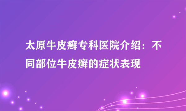 太原牛皮癣专科医院介绍：不同部位牛皮癣的症状表现