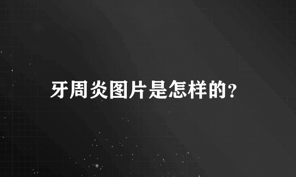 牙周炎图片是怎样的？