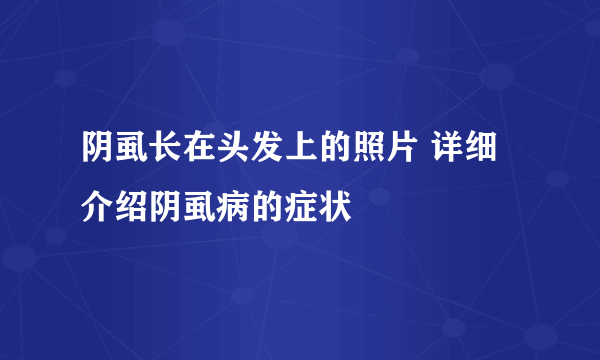 阴虱长在头发上的照片 详细介绍阴虱病的症状