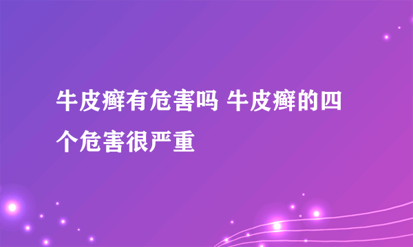 牛皮癣有危害吗 牛皮癣的四个危害很严重