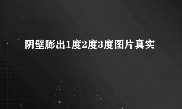 阴壁膨出1度2度3度图片真实